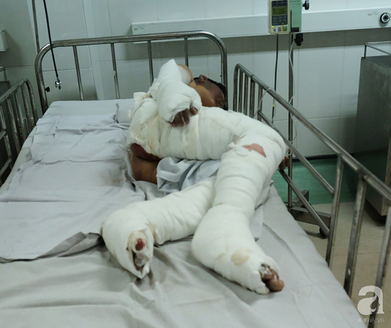 Vụ nổ hầm cầu khiến 4 người trong một gia đình bỏng nặng: Hai đứa trẻ sẽ phải mổ cắt lọc, ghép da nhiều bước